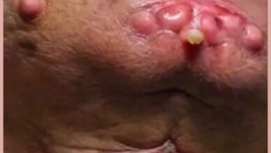 Their acne is severe