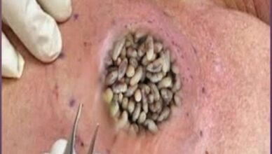 Huge Pimple, Abscess & Cyst Removal Huge Pimple, Abscess & Cyst Removal
