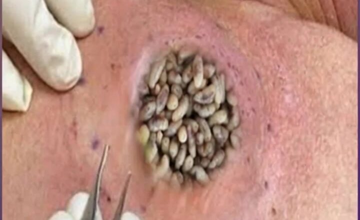 Huge Pimple, Abscess & Cyst Removal
