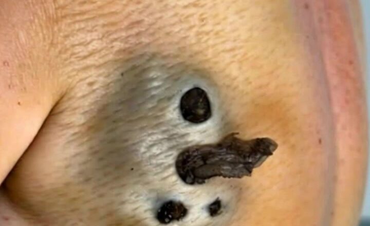 Massive Cyst Incision & Drainage
