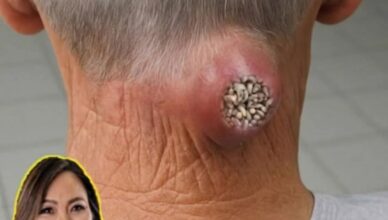Most BIG PIMPLES Compilation Most BIG PIMPLES Compilation
