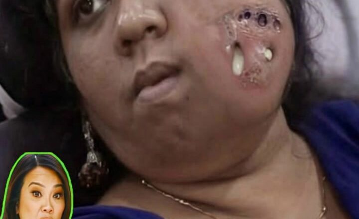 General ANESTHESIA for Face Tumor Removal