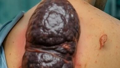 A Chicken Gizzard In His Back