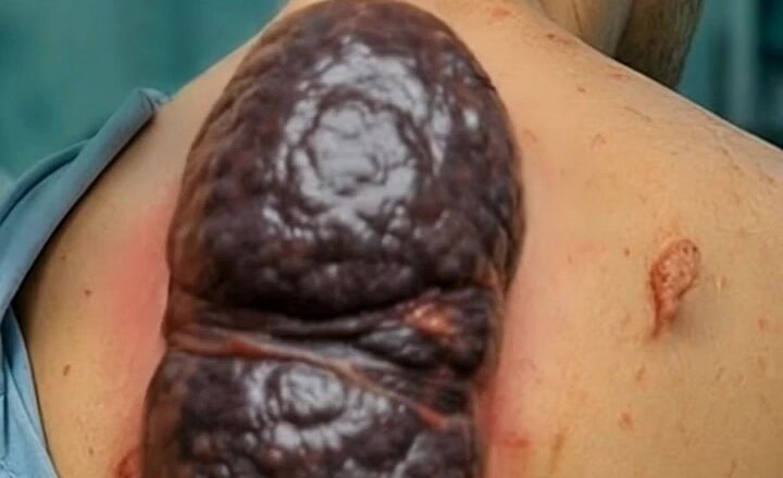 A Chicken Gizzard In His Back