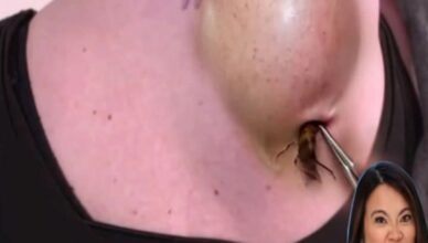 Dr. Lee Removes A HUGE Lipoma