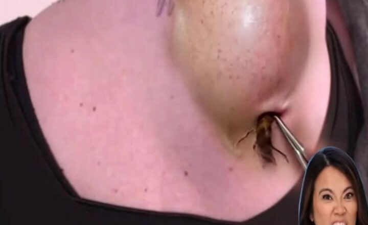 Dr. Lee Removes A HUGE Lipoma