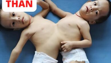 After a complex and risky operation doctors managed to separate these conjoined twin sisters