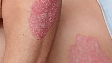 Son corps la démangeait, je pensais à une simple allergie… mais le diagnostic a été un choc