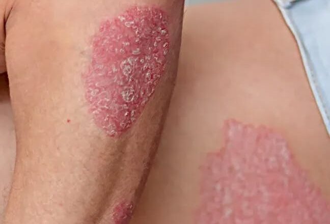 Son corps la démangeait, je pensais à une simple allergie… mais le diagnostic a été un choc