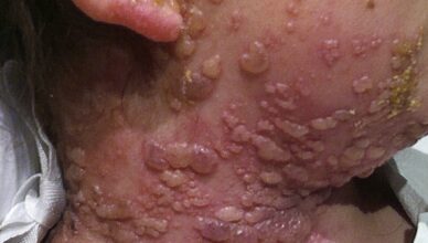 The silent condition that develops following contact with