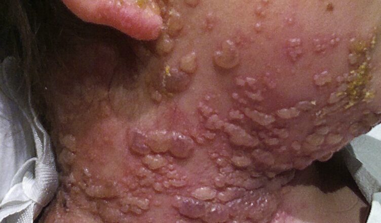 The silent condition that develops following contact with