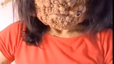 Acne occurs when hair follicles become clogged.