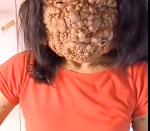 Acne occurs when hair follicles become clogged.