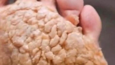 Risks Associated with Ignoring Fungal Infections