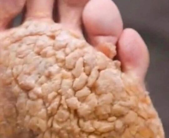 Risks Associated with Ignoring Fungal Infections
