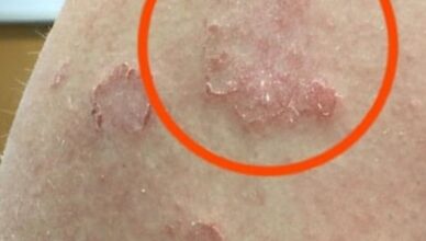 If you notice red marks appearing on your arm, it could be a warning sign of a serious underlying condition…