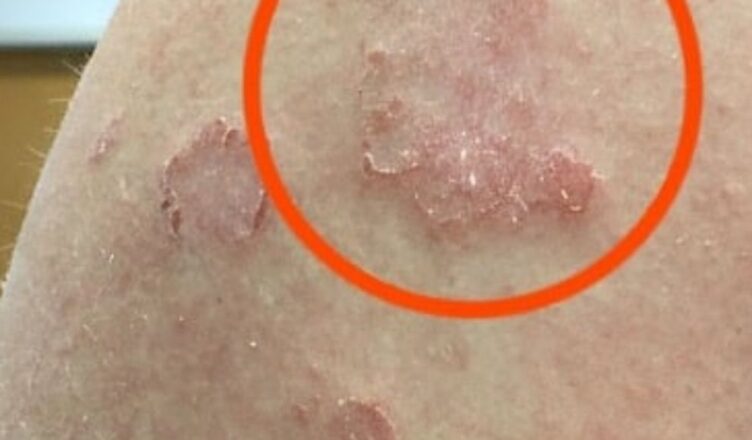 If you notice red marks appearing on your arm, it could be a warning sign of a serious underlying condition…