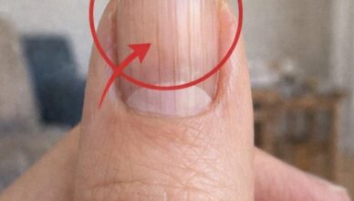 If you notice lines on your nails, it could indicate a number of different things about your health… or sometimes nothing serious at all.