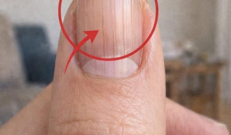 If you notice lines on your nails, it could indicate a number of different things about your health… or sometimes nothing serious at all.