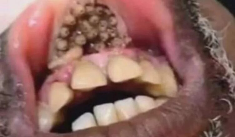 Dad Left Unrecognizable After Losing His Lips And Four Limbs To Flesh-Eating Bacteria – This Is What He Looks Like Today