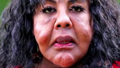 Injected with Cement: Her Unbelievable Transformation 14 Years Later