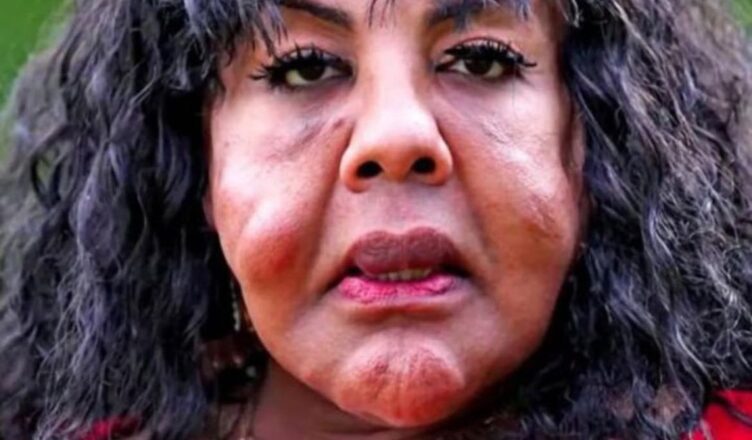Injected with Cement: Her Unbelievable Transformation 14 Years Later