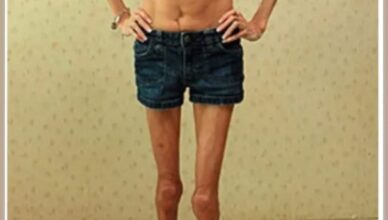 World’s Thinnest Woman Receives Fan Mail to Be Like Her