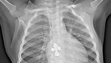 Shocking incident: A 2-year-old child swallowed a cross while sleeping and ended up in the hospital. What is their condition?